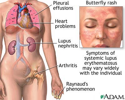 Lupus Eritematosus Disseminata